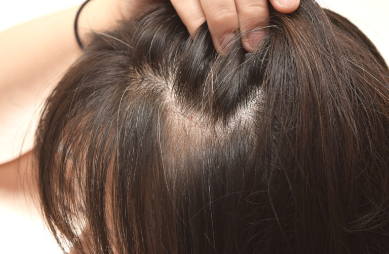 Patchy hair loss on the side of the head