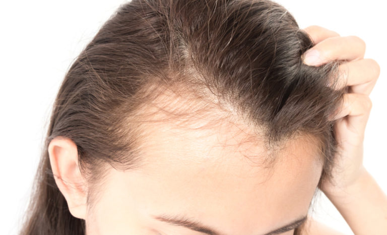 Receding hairline due to excessive hair loss