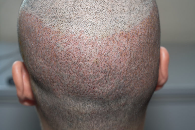 Follicular unit extraction on existing hair