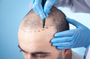 FUT Hair Transplantation and Other Techniques