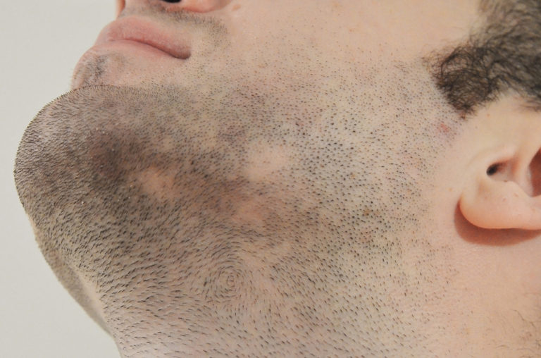 Detail oriented facial hair transplant