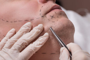 What to expect from a beard hair transplant