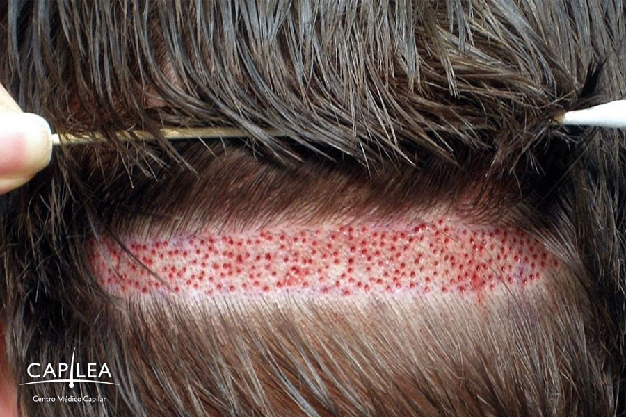 After hair transplantation you should take care of your scalp. 