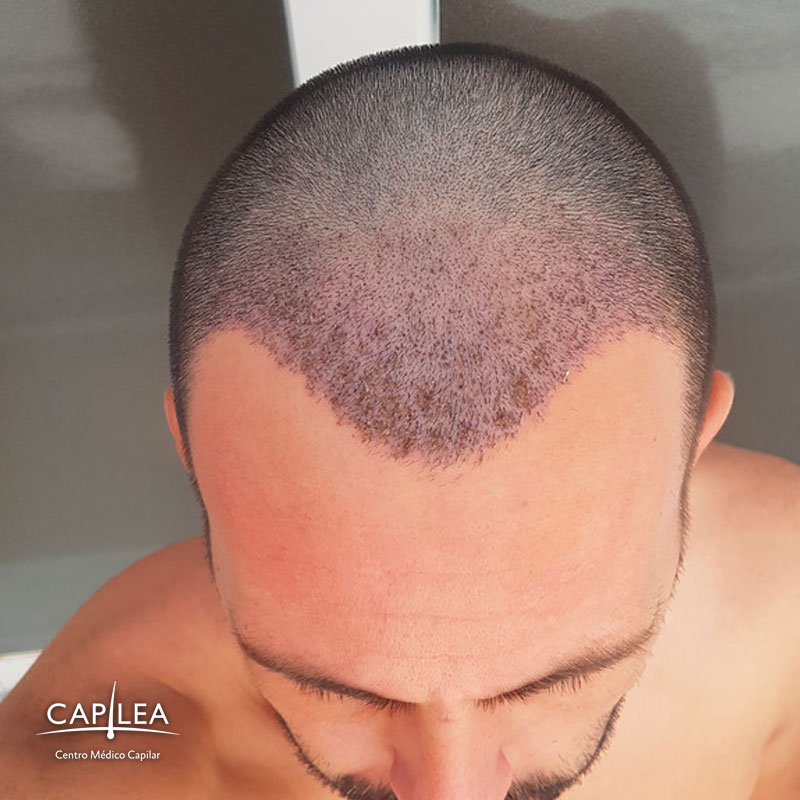 Don't touch the newly transplanted hairs, it helps the recovery.