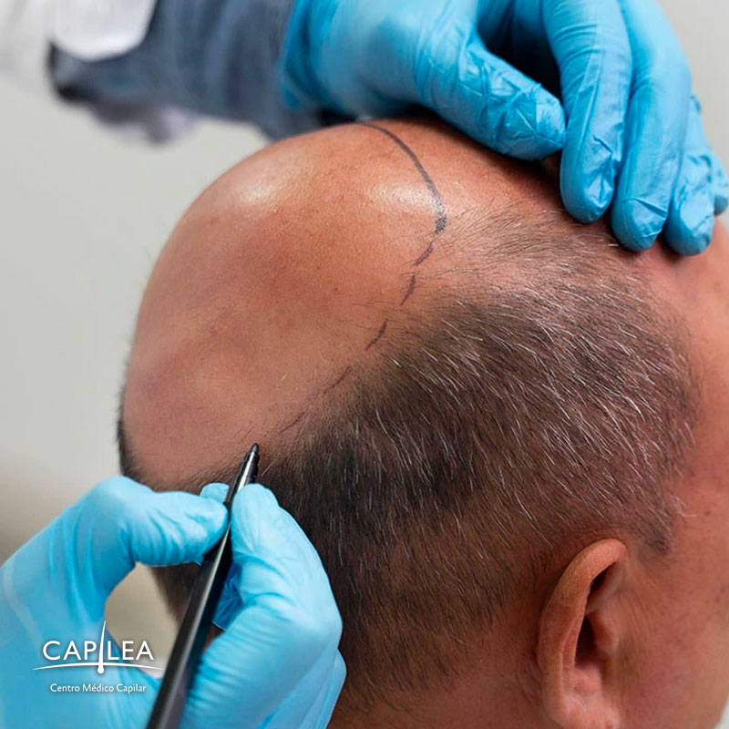 The hair transplant procedure isn't painful and takes one day. 