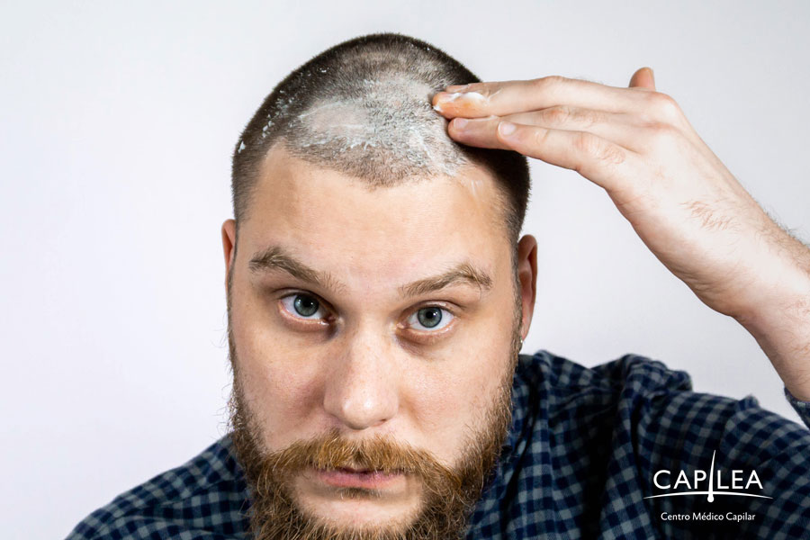 All you need to know about scabs after a hair transplant