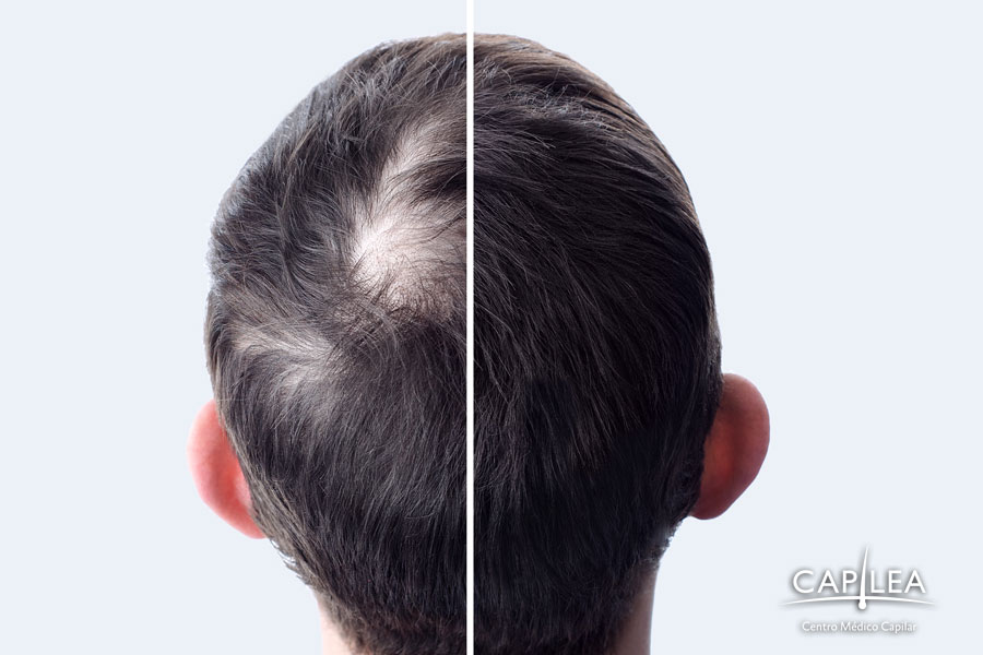 Hair loss is difficult and causes insecurity, and a hair transplant can improve hair and confidence.