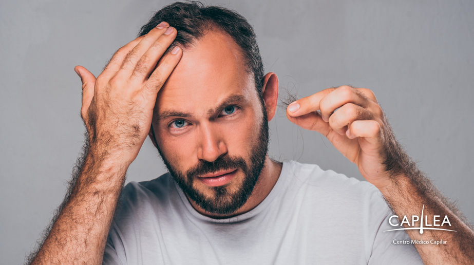 In Mexico, 5 of 10 men have androgenic alopecia. 