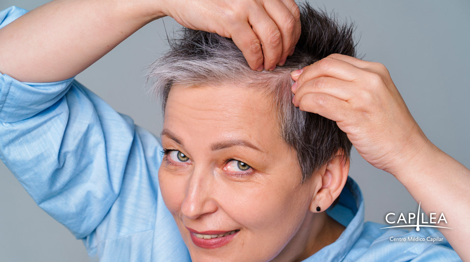 La alopecia femenina es una enfermedad que afecta a gran parte de las mujeres en edad madura. 