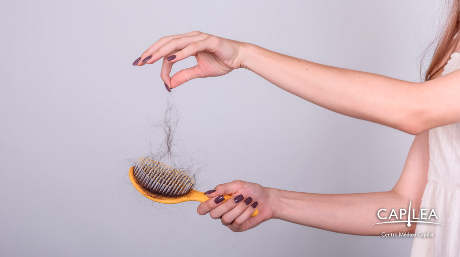 Dejar grandes cantidades de cabello en el cepillo es común en las mujeres con alopecia. 