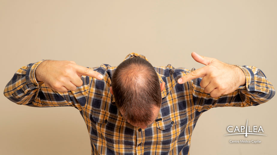 If you are experiencing hair thinning, you probably have baldness. 