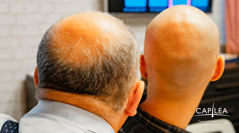 If your dad or mom has baldness, you might suffer from this condition.