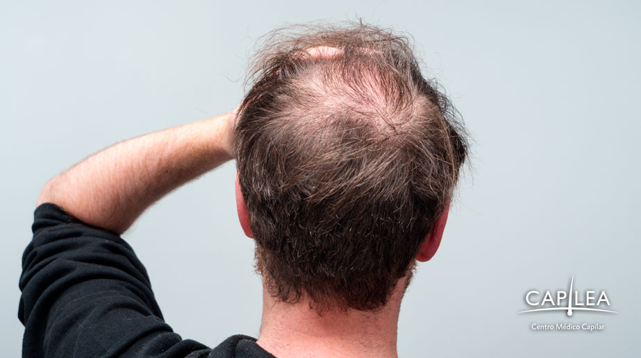 La causa más común de la alopecia es un trastorno hereditario.