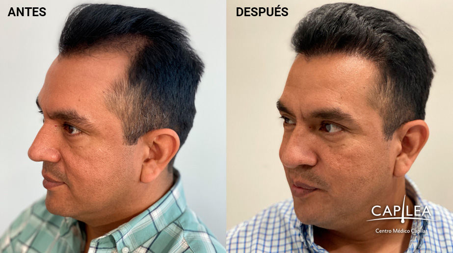 Before and after hair transplants in Capilea.
