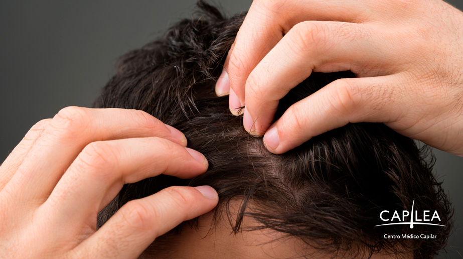 Excessive hair loss can be troubling.